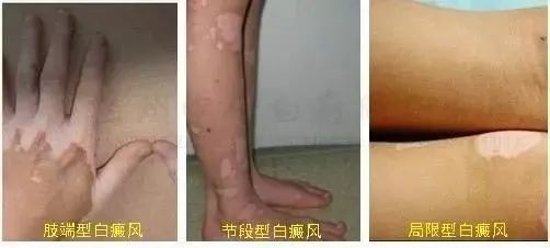 11白癜风的早期症状是什么样子的临沂皮肤病医院哪家好