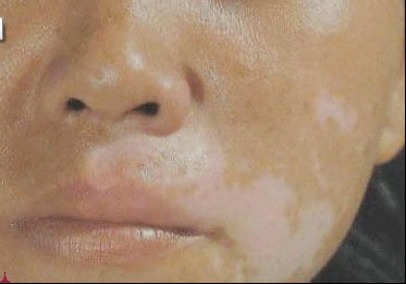 白癜风患者要注意的治疗误区 白癜风患者要注意的治疗误区